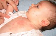 عرق سوز شدن پوست نوزاد و درمان آن